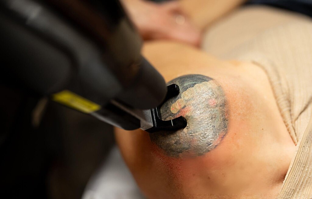 tattoo_removal